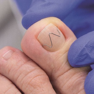 Nieuw! Revolutionaire Nagelbeugeltechniek Naspan®-Platinum